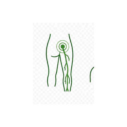 Sciatica