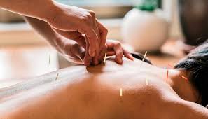 Acupuncture