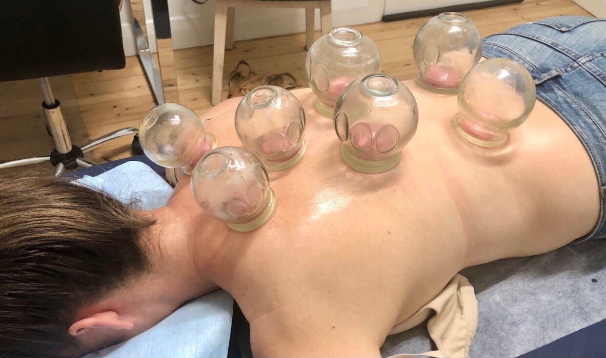 Fire Cupping